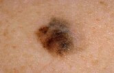 Experimental Melanoma Vaccine Shows Early Promise