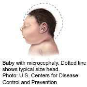 Zika May Have Caused Death of Texas Newborn Baby had severe birth defect linked to mother’s infection with the virus acquired outside U.S., officials say