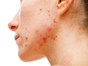 Acne Yields Up Secret That Points to New Treatments Bacteria on skin sometimes release fatty acids that trigger inflammation, researchers report
