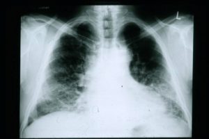 congestive heart failure chest x-ray