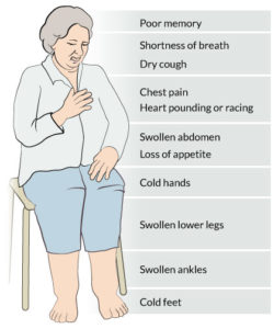 congestive heart failure symptoms image